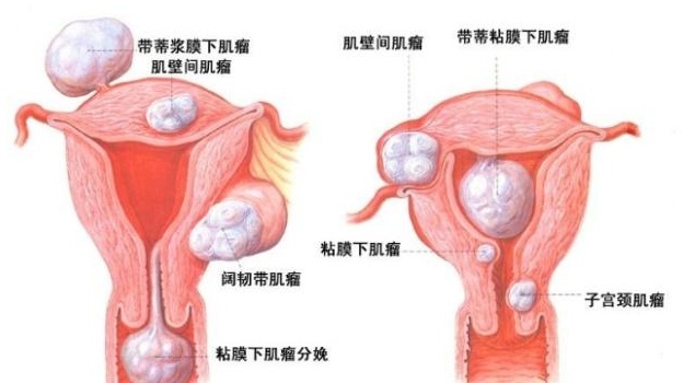 子宫肌瘤是怎么引起的 六种因素引起子宫肌瘤